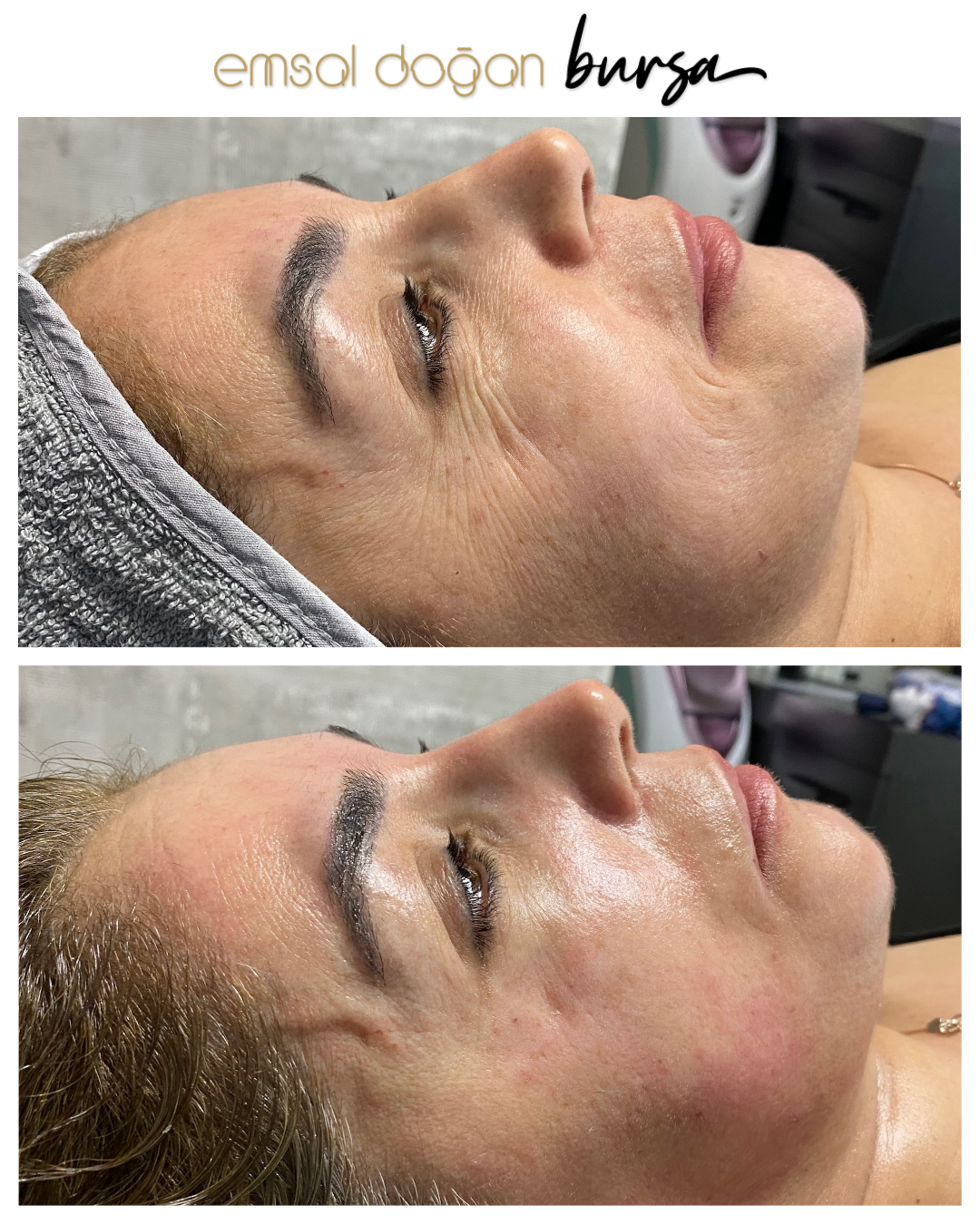 Hydrafacial Önce Sonra